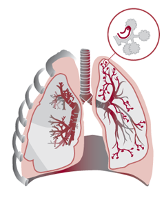 Hk Strickland, colour digital drawing of lungs
