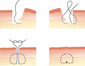 Hilary Strickland - Design, Illustration, Medical Illustration, Sutures, Bath